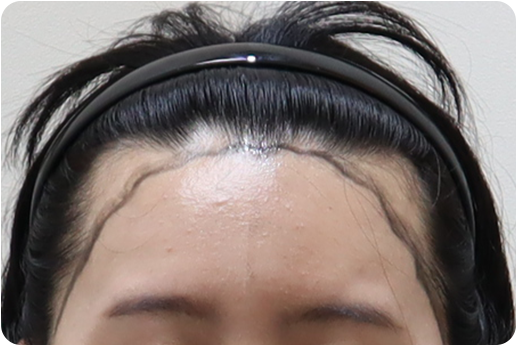 여성모발이식2_2