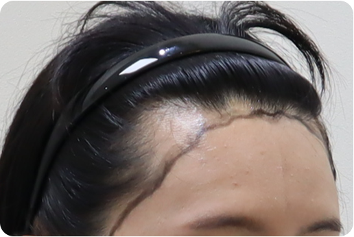 여성모발이식2_3