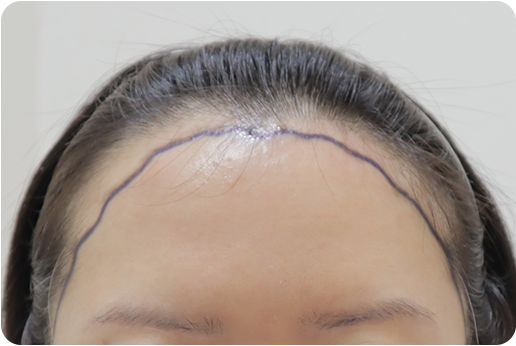 여성모발이식2_4