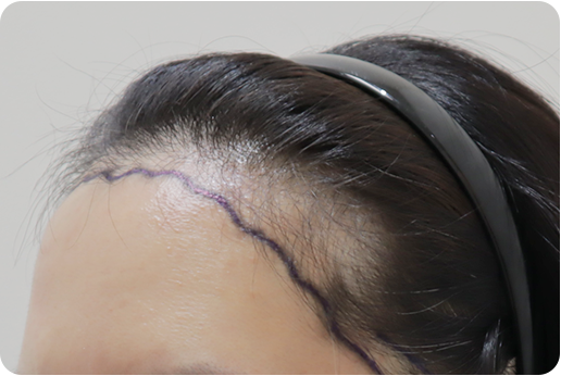 여성모발이식2_5