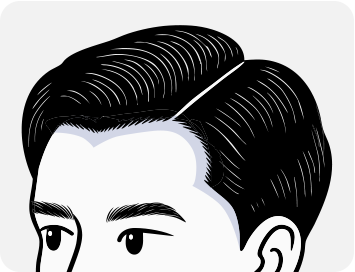 남성모발이식4_1