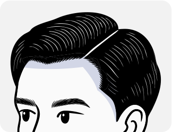 남성모발이식4_2