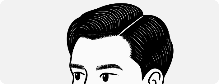 남성모발이식4_2