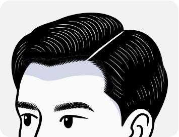 남성모발이식4_3