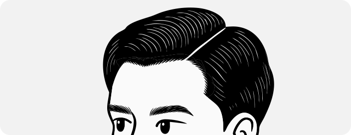 남성모발이식4_3