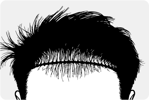 재수술대량모발이식2_1