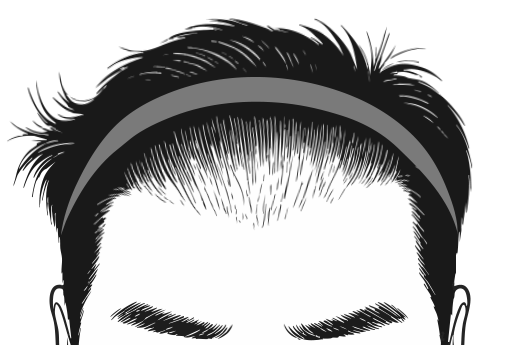 재수술대량모발이식3_1