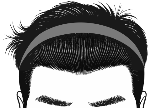 재수술대량모발이식3_2