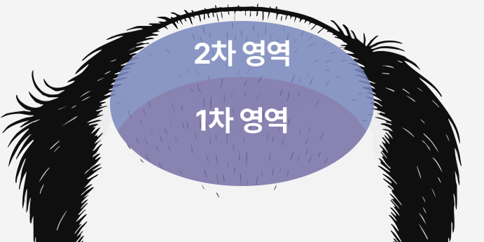 재수술대량모발이식5_1