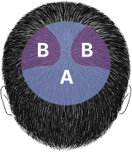 재수술대량모발이식5_2