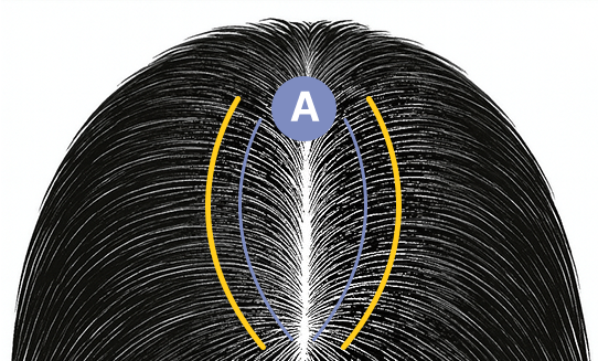 재수술대량모발이식6